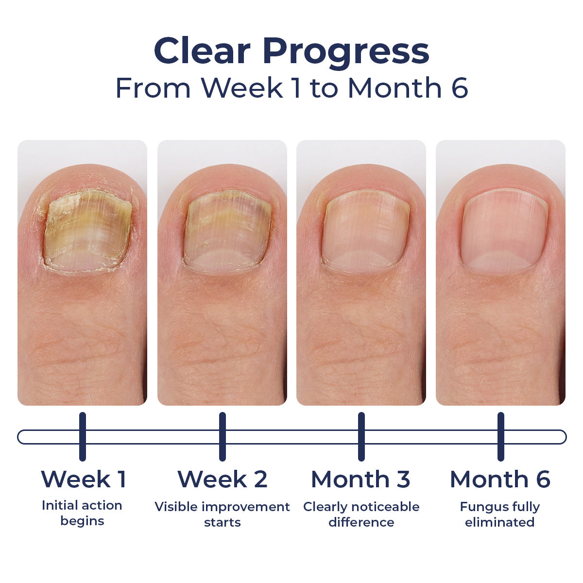 Levavia - Anti Fungal - Nail Care Pen